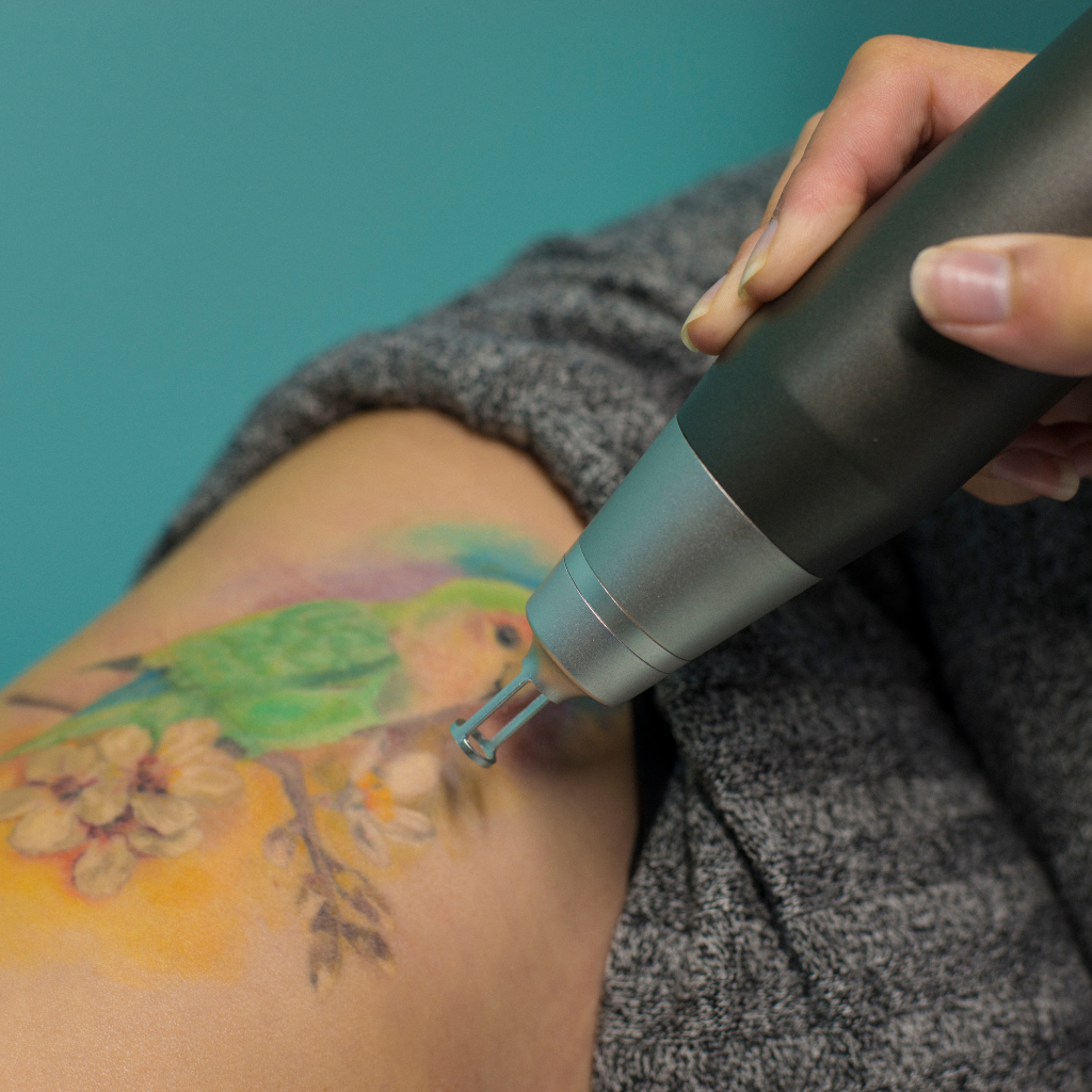 ELIMINACIÓN DE TATUAJES