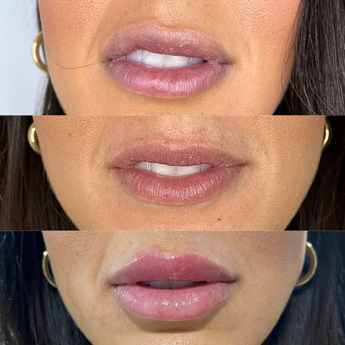 Corrección Labial