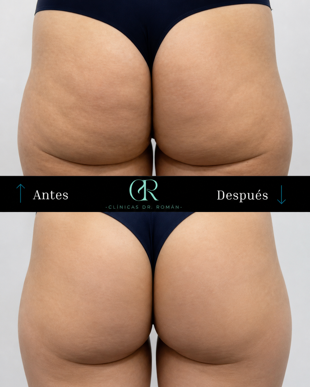 Remodelación glúteos