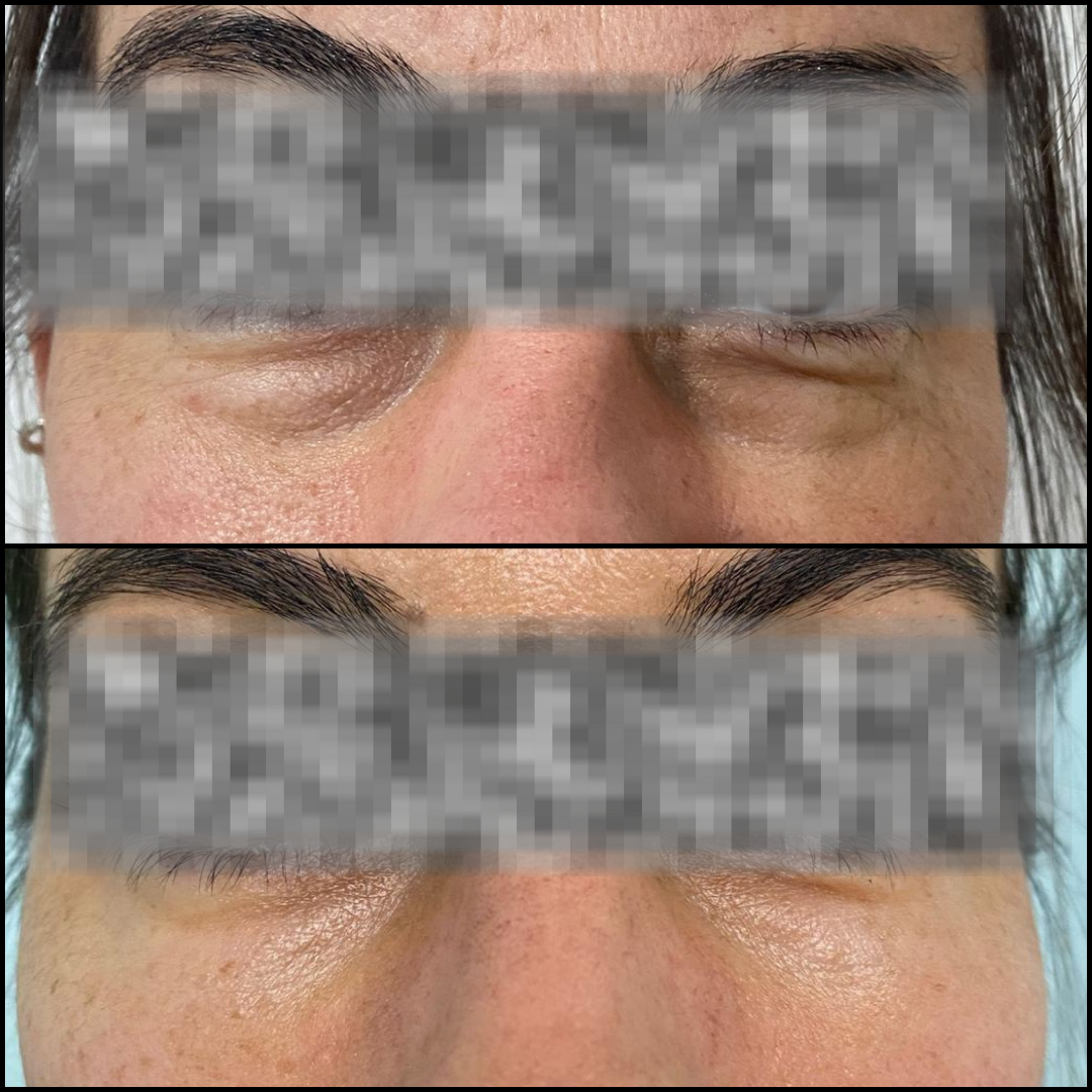 Relleno de ojeras