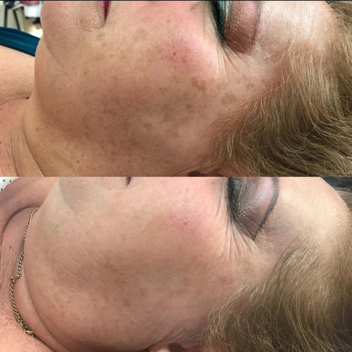 Bono Hiperpigmentación