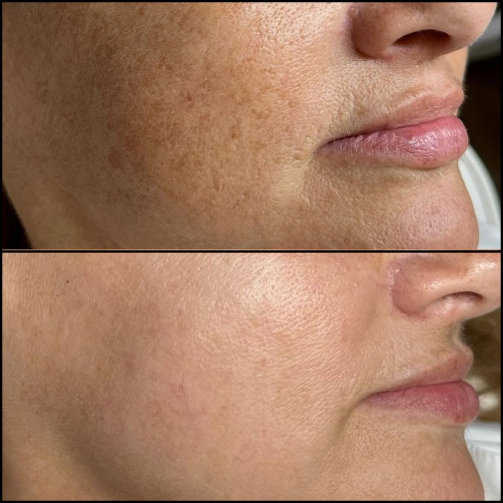 Peeling Químico