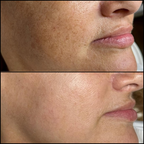Peeling Químico