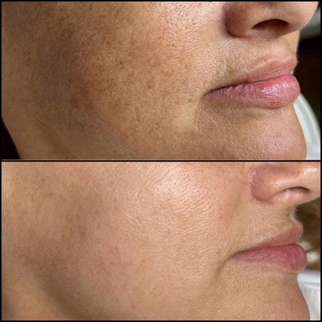 Peeling Químico