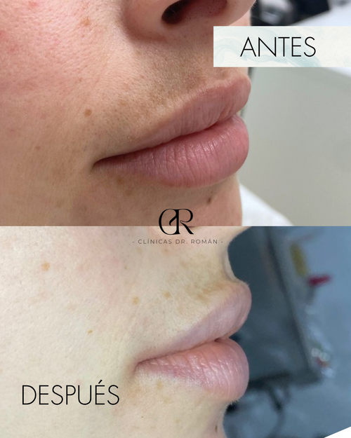 Bono Melasma