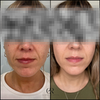 Radiofrecuencia Facial