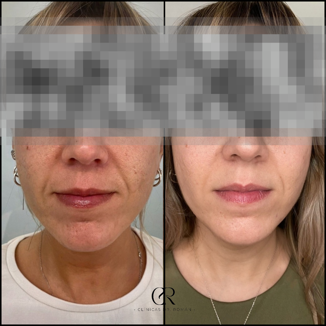 Radiofrecuencia Facial