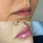 Remodelación Labial
