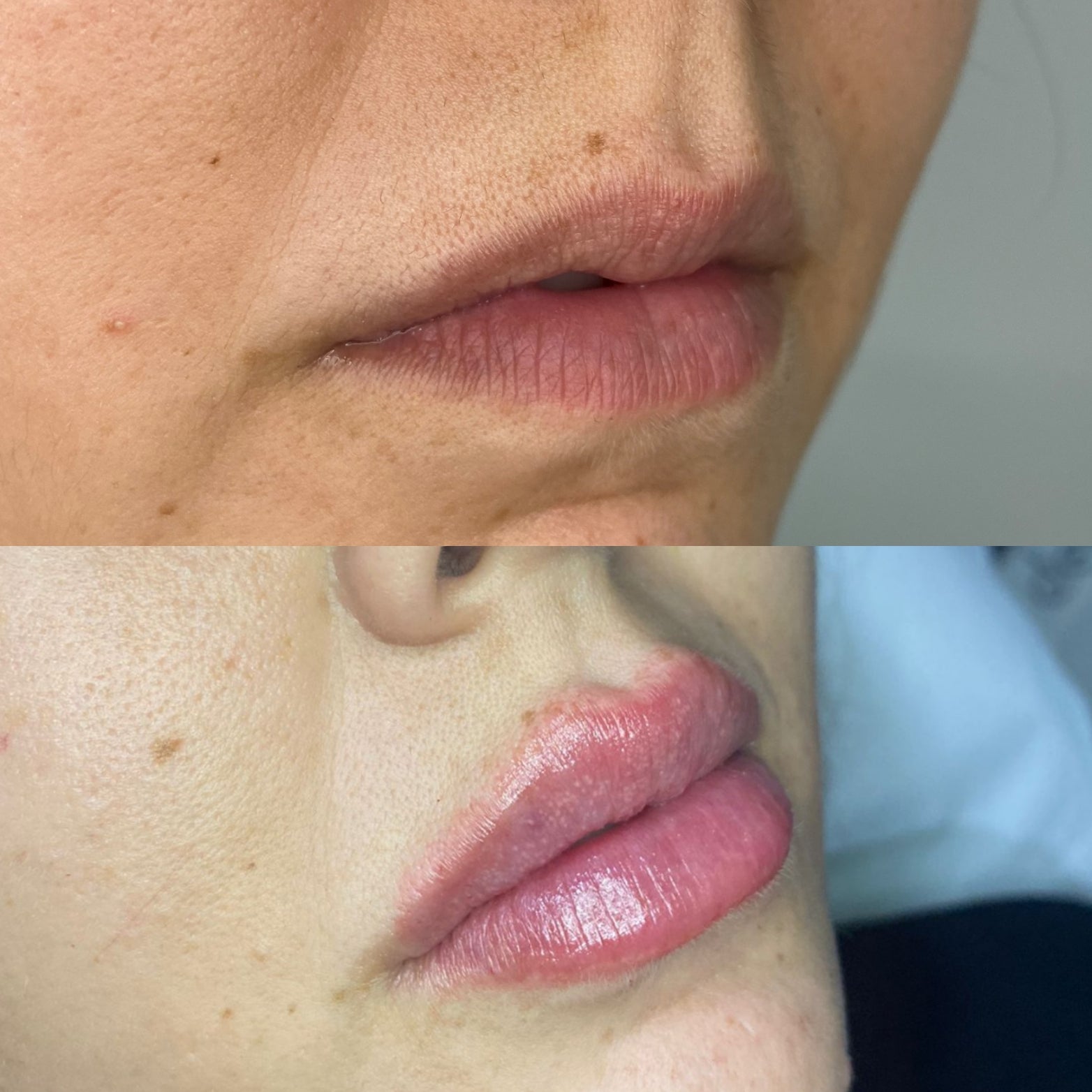Remodelación Labial