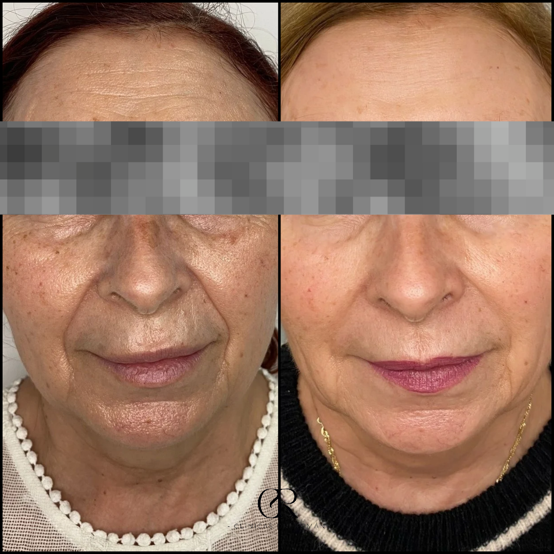 Full Face Redensificador