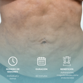 Fibrosis Post Quirúrgico
