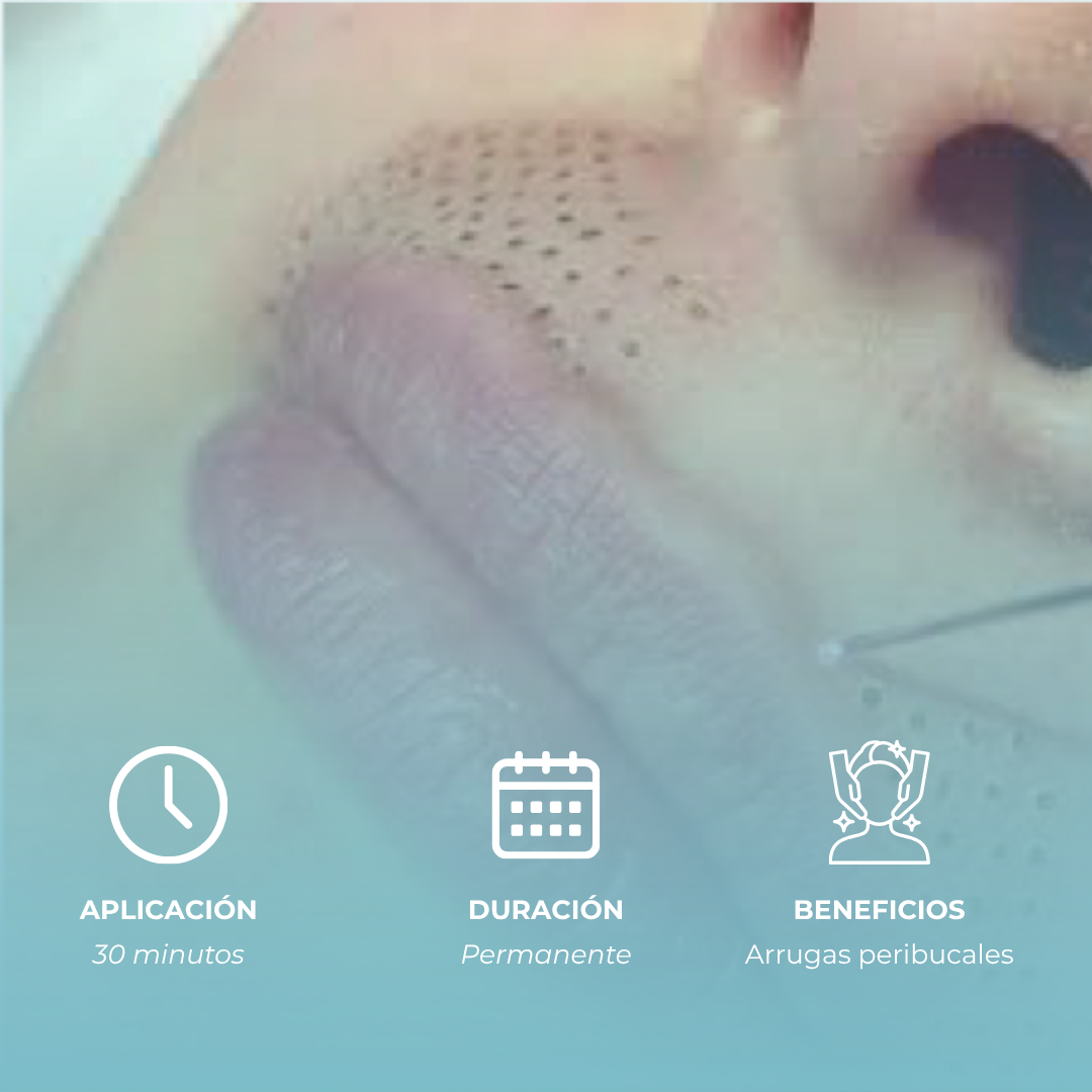 Plasmage Peribucal