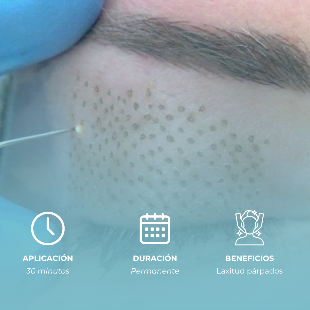 Blefaroplasma