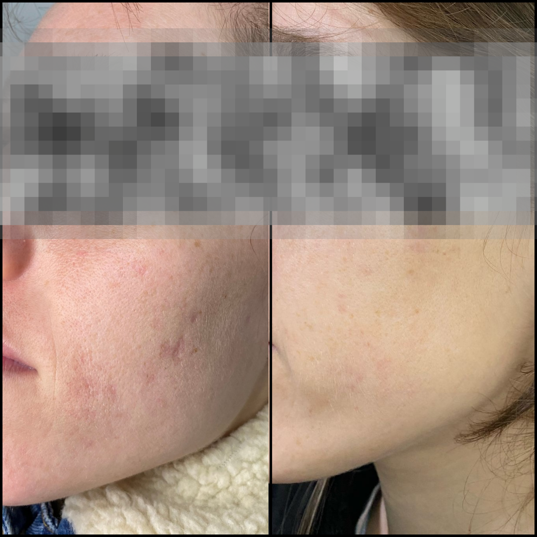 Microneedling