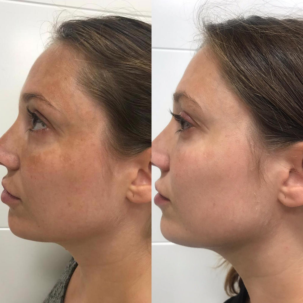 Peeling Mascarilla Intensa