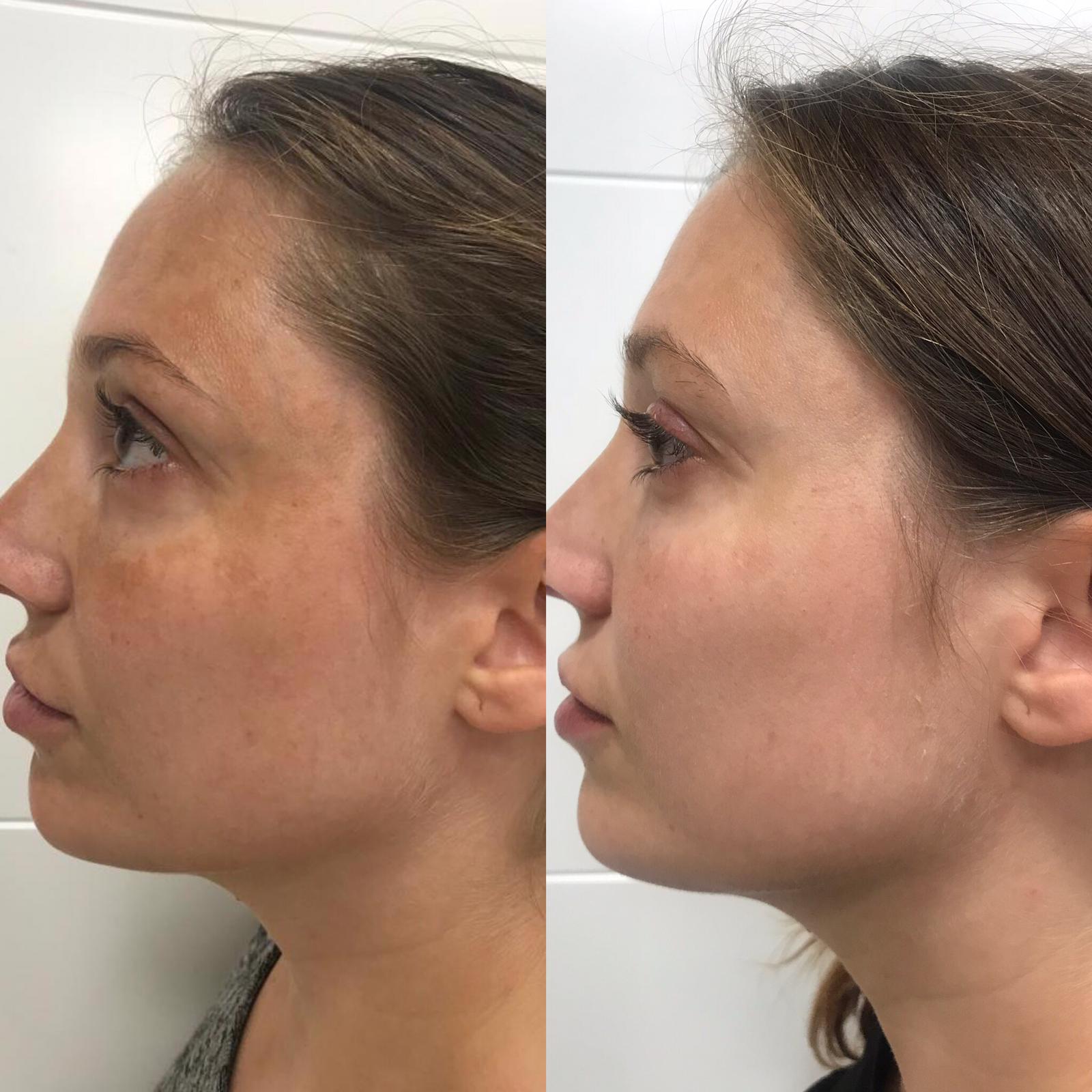 Peeling Mascarilla Intensa