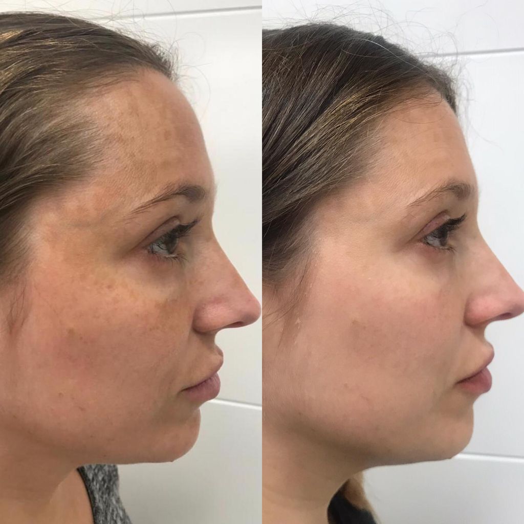 Peeling Mascarilla Intensa