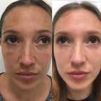 Peeling Mascarilla Intensa