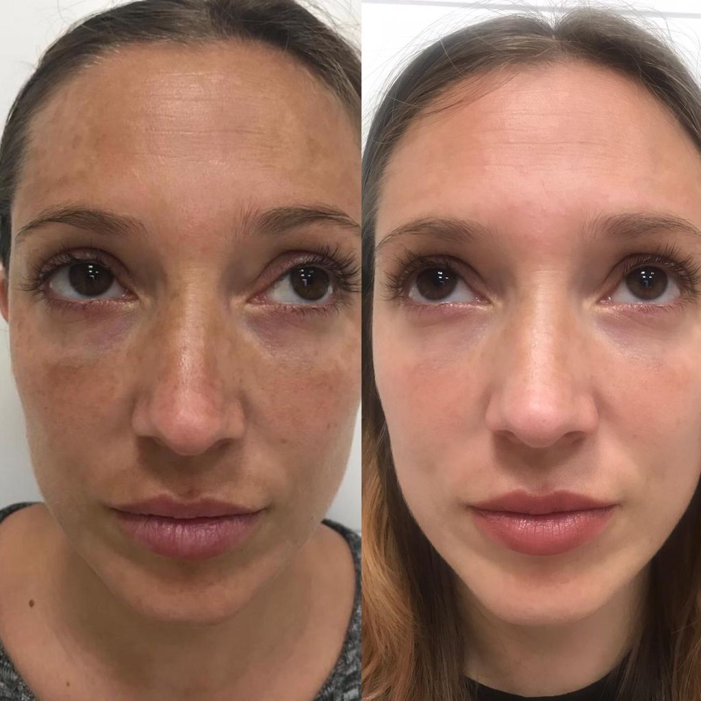 Peeling Mascarilla Intensa