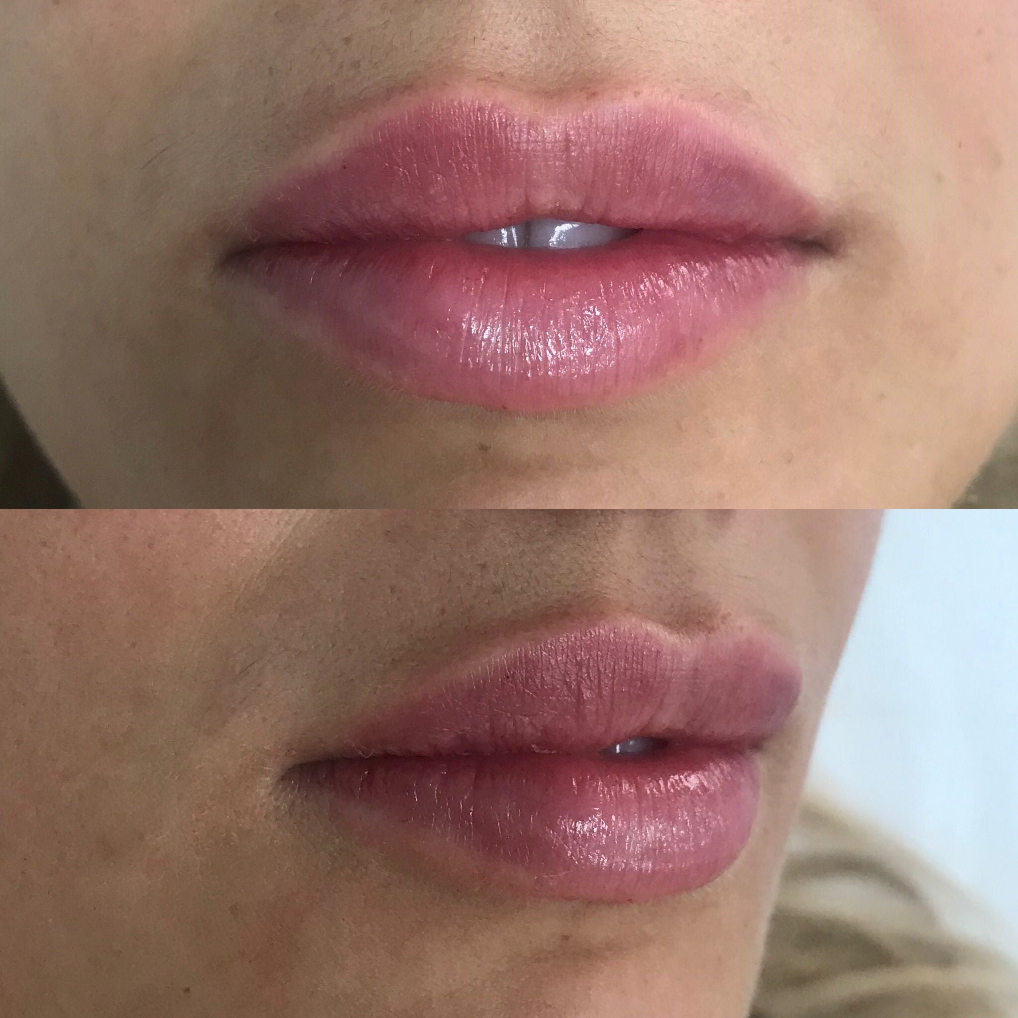 REMODELACIÓN LABIAL