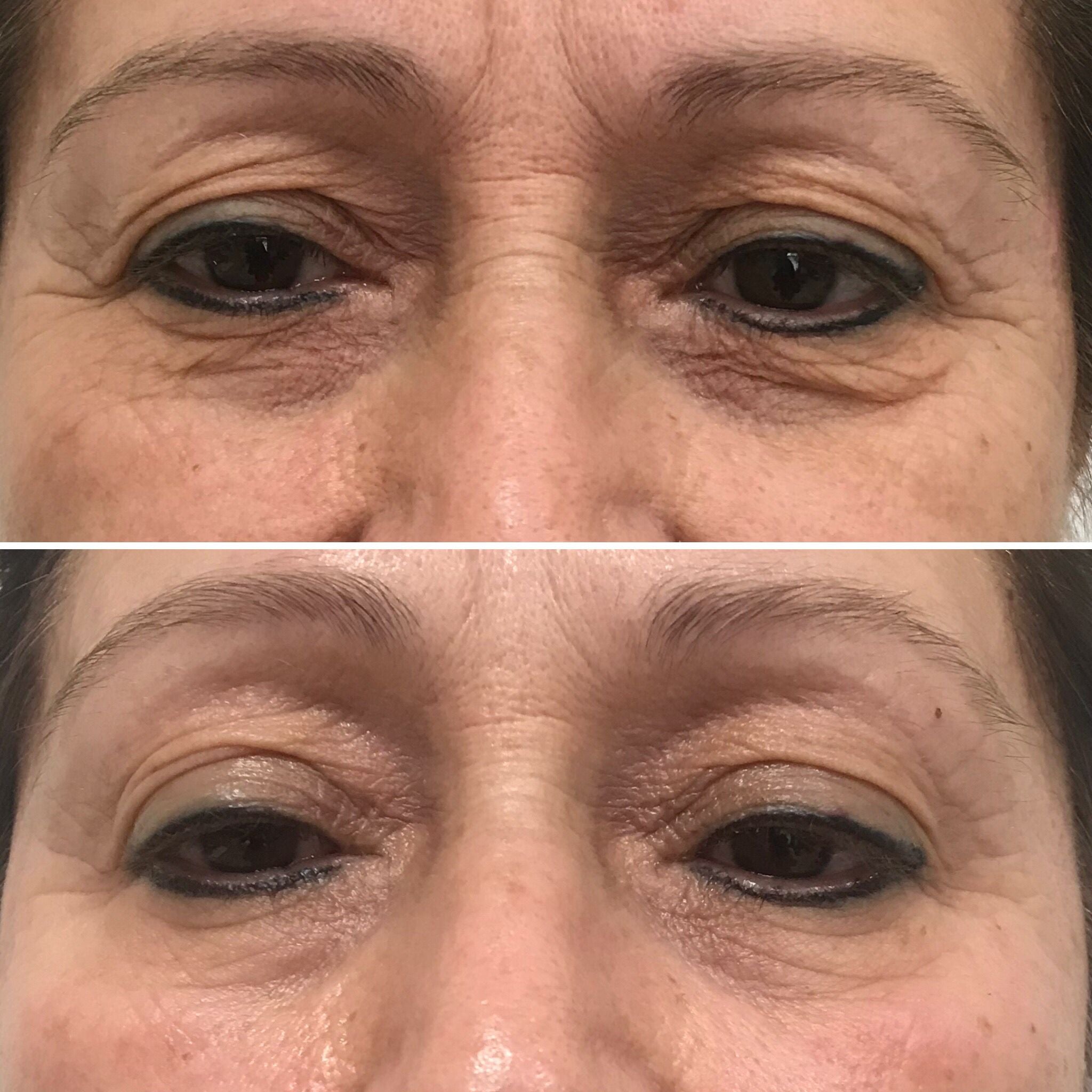 BLEFAROPLASMA